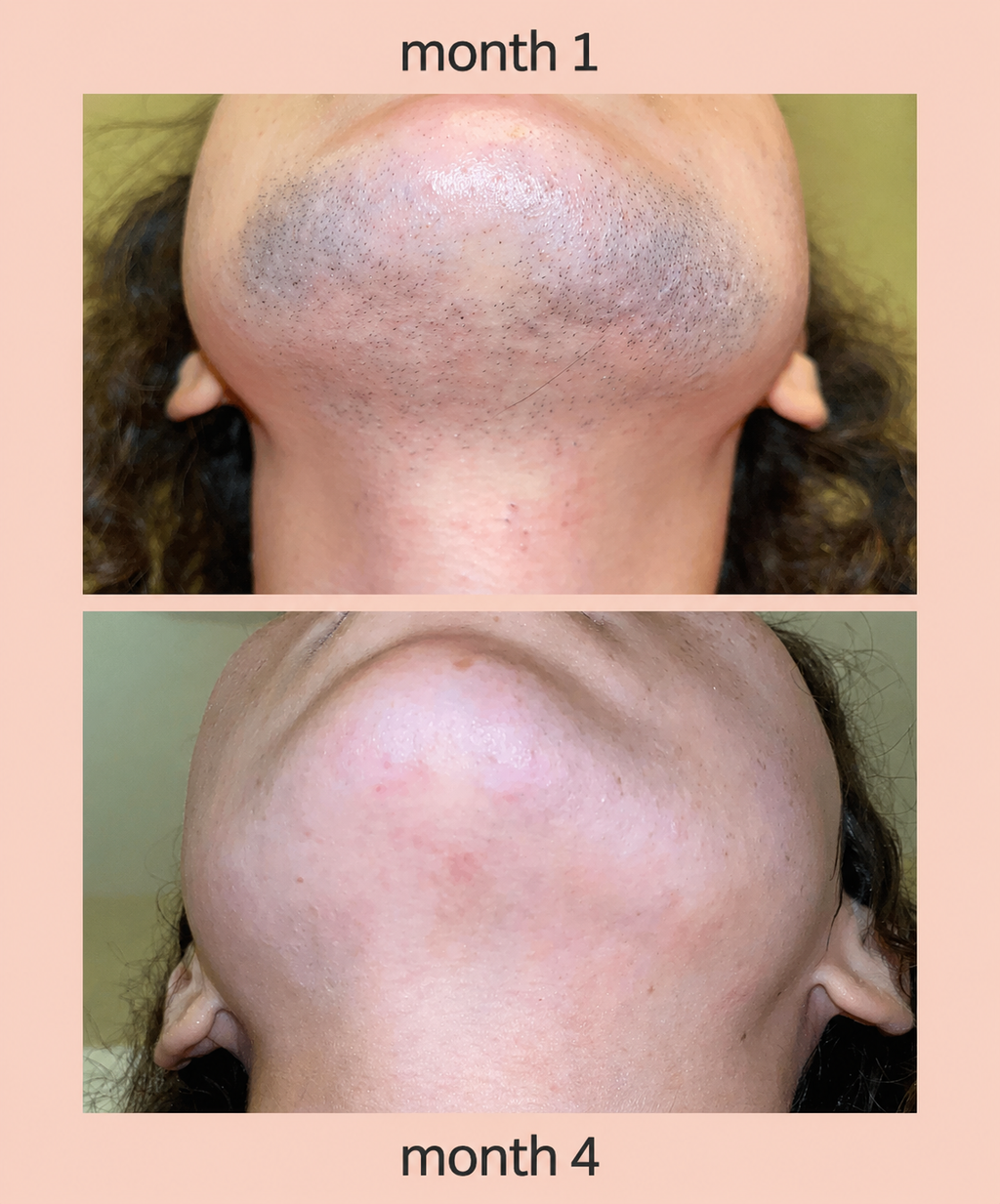 Myo & D-Chiro Inositol For PCOS Hirsutism