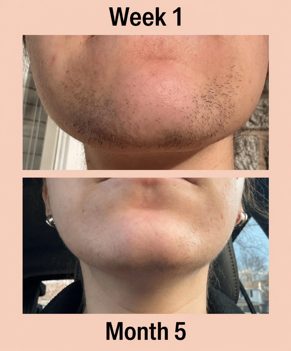 Myo & D-Chiro Inositol For PCOS Hirsutism