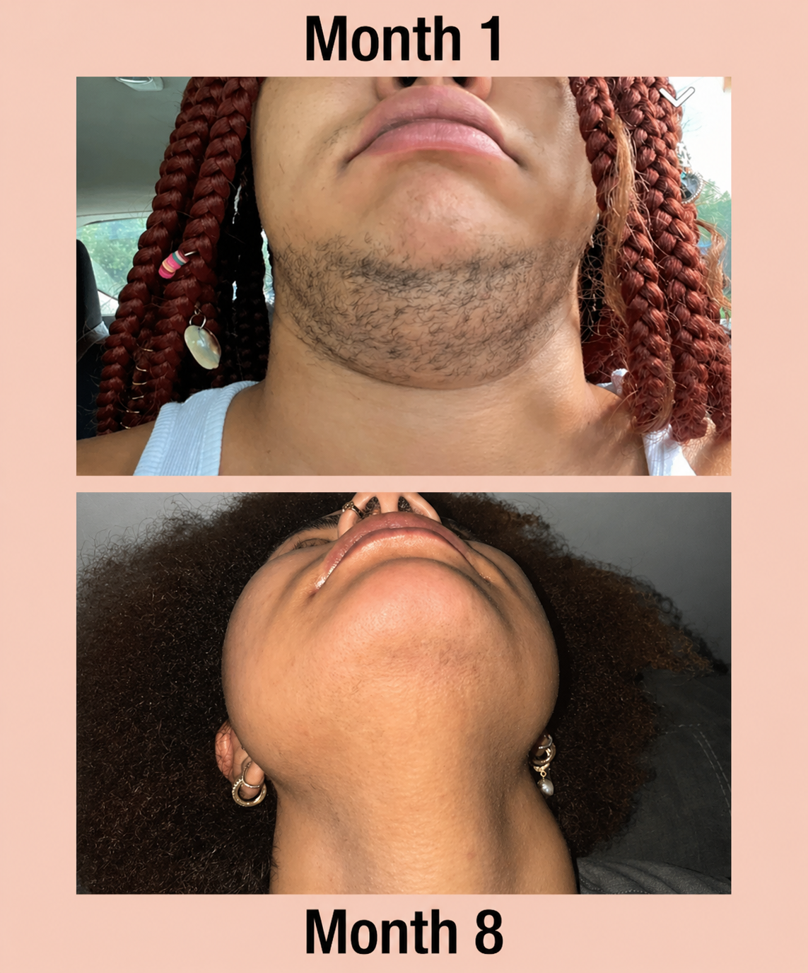 Myo & D-Chiro Inositol For PCOS Hirsutism